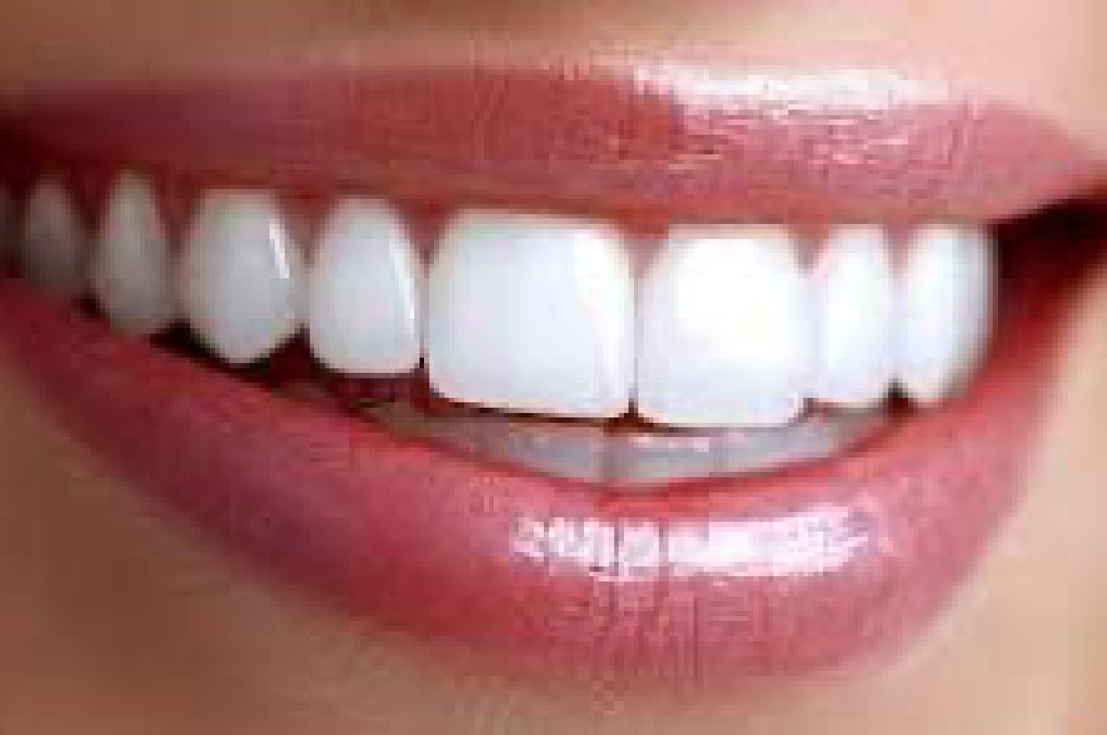 Deluxe Tooth Whitening Kit; $279 Value! | Jewish Family Services of WNC ...